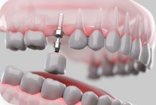 Dental implant